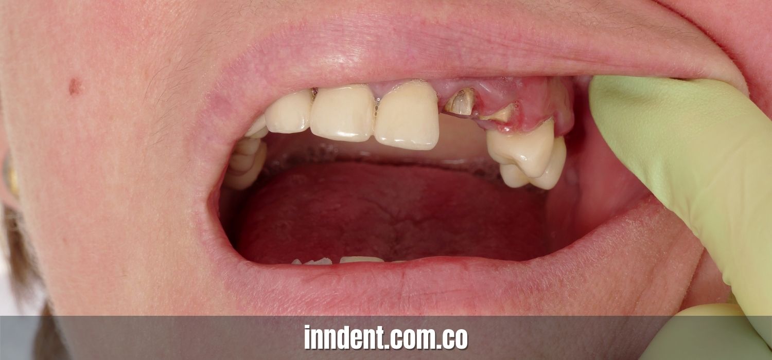 Tipos De Fracturas Dentales Inndent 4248